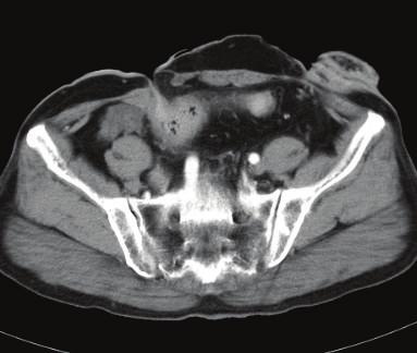 Magnetic resonance imaging (MRI) revealed a megarectum (white double open circles)