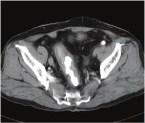(c) (d) Figure 3: CT performed after surgery indicated that the rectal dilation had