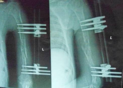 fracture site in our case with