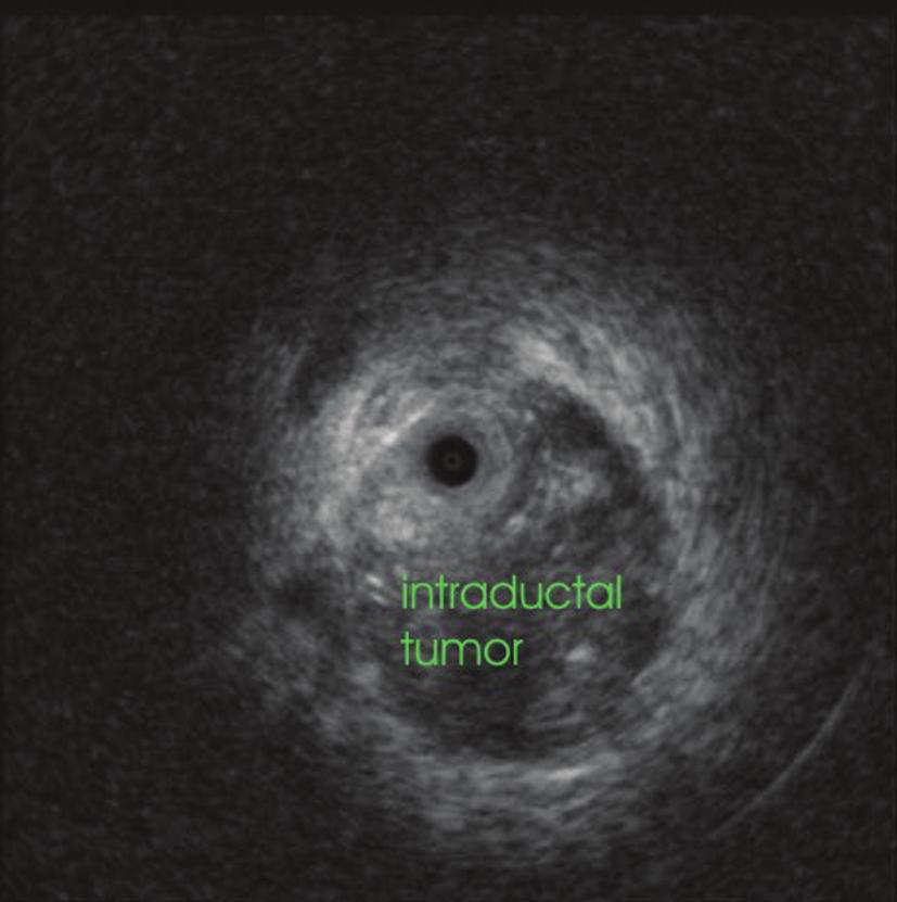 In PSC, suspect inhomogenous areas may be located by means of IDUS, thus allowing selective endoscopic transpapillary or cholangioscopic biopsies.