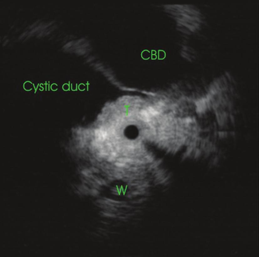 Intraductal ultrasonography for biliary and pancreatic strictures 221 and in selected cases can bring useful data for the management of the biliary and pancreatic pathology.