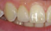 The combination of opalescence and strength allows me to fabricate thin restorations that are at a
