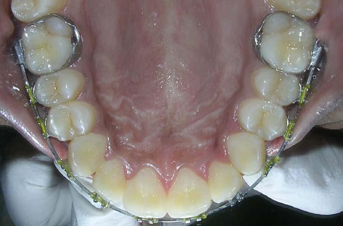 The patient had an apparently symmetrical mesoprosopic face, competent lips His smile was non-consonant type with 50% upper incisors and some amount of lower gingival visible.