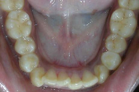 Periodontium appeared healthy with mild melanin pigmentation of attached gingiva. Lower incisors were retroclined and crowded. Reverse over jet and mild increased overbite.