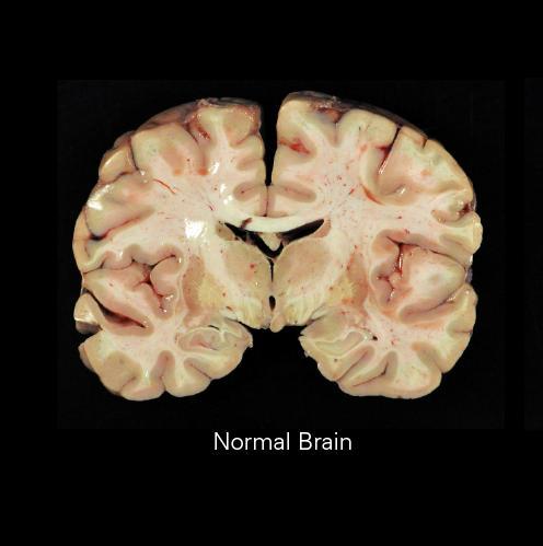 Chronic Traumatic Encephalopathy Chronic traumatic encephalopathy (CTE) is a progressive neurodegenerative disease characterized by the abnormal accumulation of