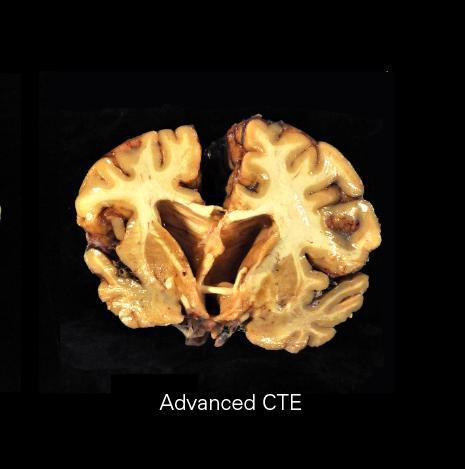 examination of the brain at autopsy Acta Neuropathol. 2016 Jan;131(1):75-86. doi: 10.1007/s00401-015-1515-z. Epub 2015 Dec 14.