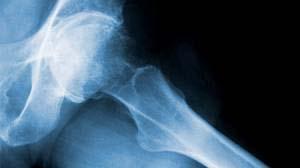 bone mass Risk of fracture Slowed linear growth Bone