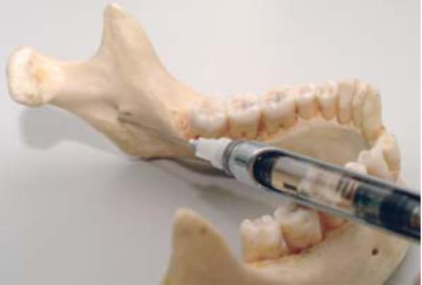 The syringe barrel repositioned forward over the lateral incisor or canine. Reprinted with permission of Elsevier from Malamed. 3 All rights reserved. Figure 7. A. The needle inserted too far and not making contact with the bone.