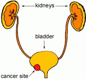 Society estimates 74,690 new cases of bladder cancer