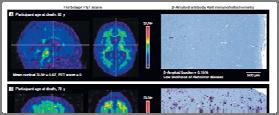 Amyloid PET Imaging RED = maximum uptake VIOLET = minimum uptake New Possibilities for Early Detection (Novel Biomarkers) Brain PET Imaging of Inflammation Inflammation in the brain is clearly