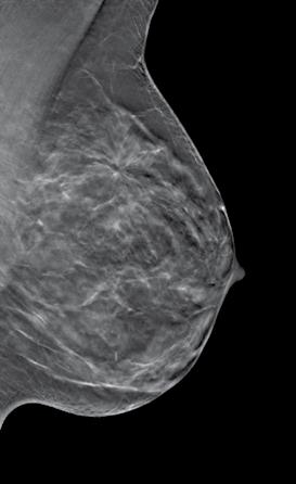 3D mammography: A new dimension in early breast cancer detection What if we could find breast cancers earlier? 1-3 What if doctors could see lesions more clearly?