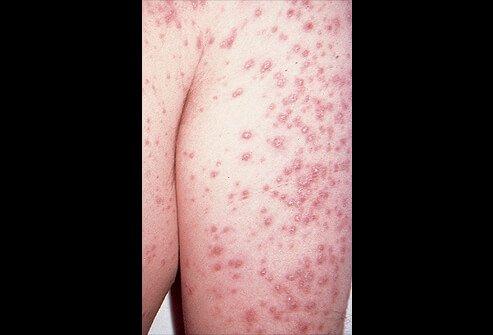 red papules of disseminated