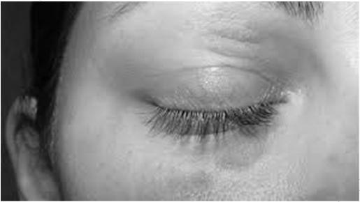 Eyelids and periocular area Irritant or allergic