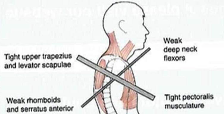 A common posture problem, UCS describes a chronic