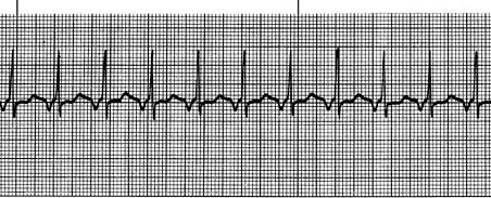 MECANISMELE STOPULUI CARDIAC DEM cu complexele QRS înguste cu frecvenţă crescută (pe traseu ECG se înscrie