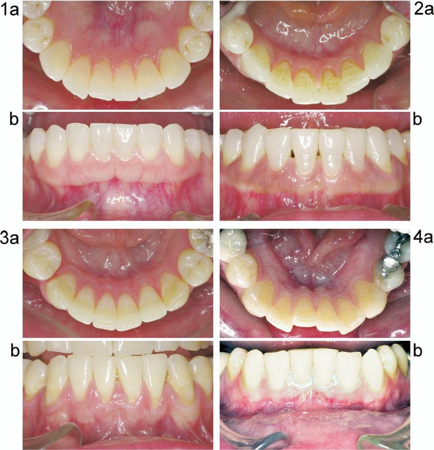 American Journal of Orthodontics and Dentofacial Orthopedics Volume 133, Number 1 Booth, Edelman, and Proffit 73 Fig 2.