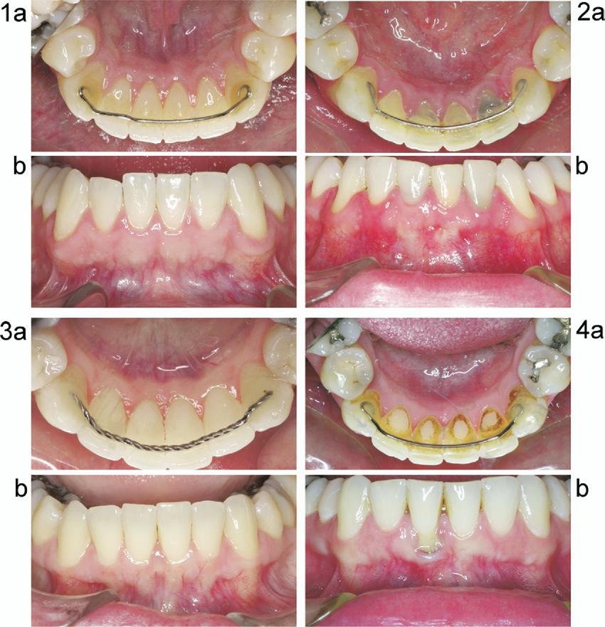 74 Booth, Edelman, and Proffit American Journal of Orthodontics and Dentofacial Orthopedics January 2008 Fig 3. The 4 patients with long-term retainers with the worst gingival index scores.