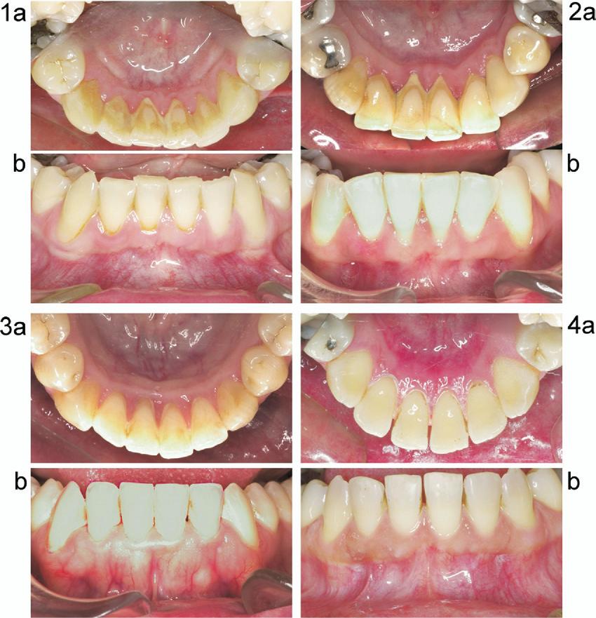 American Journal of Orthodontics and Dentofacial Orthopedics Volume 133, Number 1 Booth, Edelman, and Proffit 75 Fig 4.