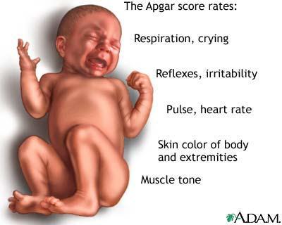 Newborn first exam APGAR Score Score 0 1 2 Heart Rate Absent <100bpm >100bpm Respiratory effort Absent, irregular Slow, crying Good Muscle tone(activity) Limp