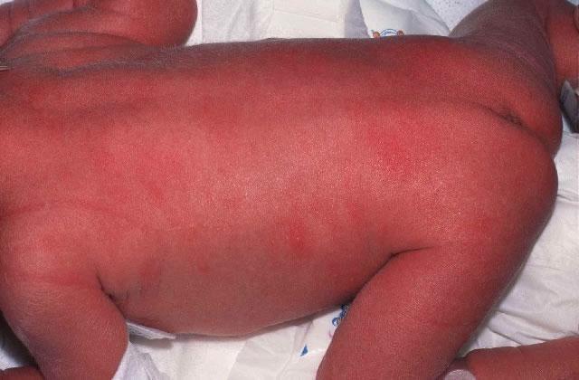 are sterile Appear in the first 3-4 days of life