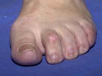 Hammer toes Toes are squashed by wearing poorly fitting shoes for long time or high heel Toe boxes Soft