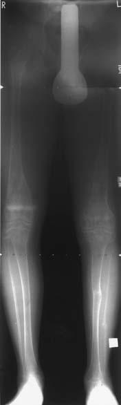 formation of regenerate in the left femur and (d) the left