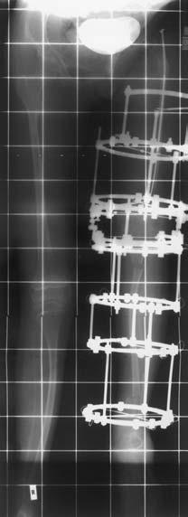Fig 2b Radiograph after the application of an Ilizarov fixator to the thin osteopenic left.