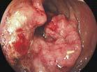 Screening for Colorectal Neoplasia in Inflammatory Bowel Disease Francis A.