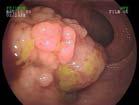 10 yrs, 8% at 20 yrs and 18% at 30 yrs Risk of CRC higher in extensive colitis patients Eaden JA, et al.