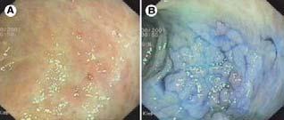 (B) Examples of type I (left) and type IV (right) lesions before and after chromoendoscopy. Kiesslich R, Neurath MF.