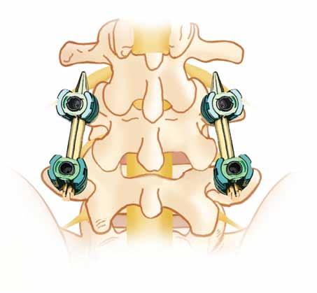 Pedicle Screws and Rods With the goal of minimally invasive surgery in mind, pedicle screws and rods are used to stabilize the spine. X-ray imaging may be used to determine the precise screw location.