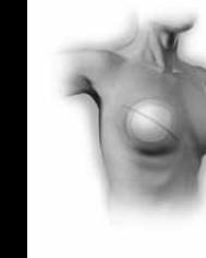 often removes skin as well as breast tissue, leaving the chest tissues flat and tight.