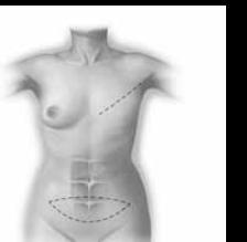 The most common types of tissue flaps are the TRAM (Transverse Rectus Abdominus Musculocutaneous flap) (which uses tissue from the abdomen) and the Latissimus Dorsi flap (which uses