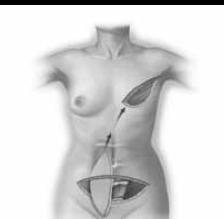 It is important for you to be aware that flap surgery, particularly the TRAM flap, is a major operation, and is more extensive than your mastectomy operation.