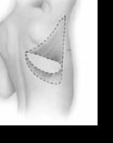 The TRAM Flap (Pedicle or Free) Step 1: Mastectomy is performed and the donor site is marked Step 2: The flap of rectus muscle and tissue is tunnelled to the breast Step 3: Final