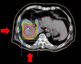 12 Comparison of dose distribution Conventional Proton beam from left and back The liver is a moving organ with respiration.