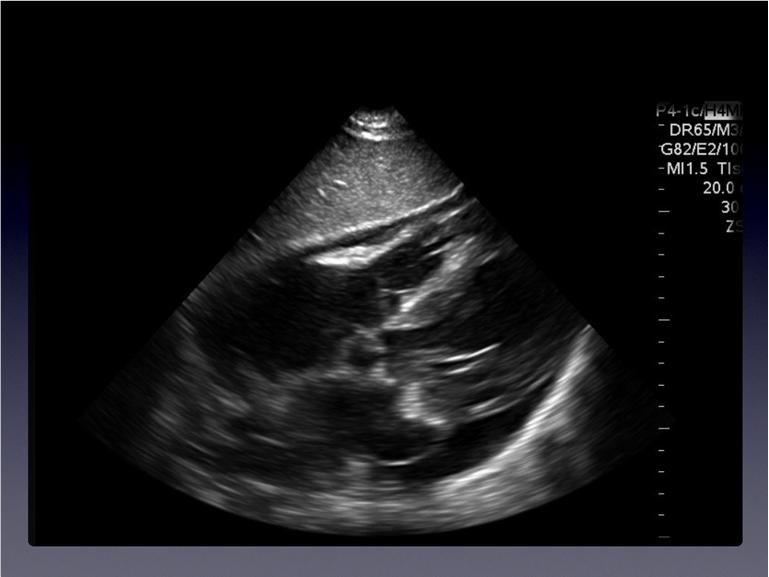 Pericardial Effusions Subxiphoid 4 Chamber Pericardial