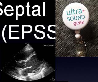 Septal Separation (EPSS) Shortest distance from anterior mitral valve leaflet to LV septum Strong inverse
