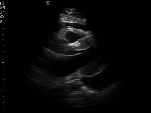 RV Collapse? Tamponade M-Mode Is it collapsing in Diastole?