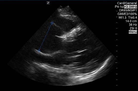 Advanced Finding Dilated Aortic Root 90% of Ascending aortic dissection have