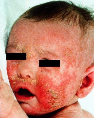 secondary infection Eczematous