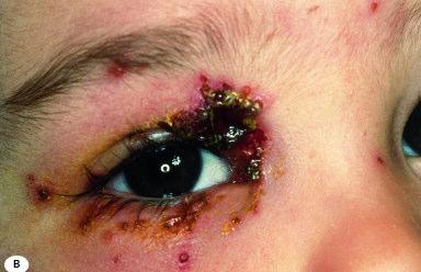 Primary infection Eruption spread to normal Febrile, small vesicles skin appear in area of