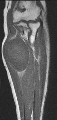 lower extremities showed iso uptke. Most inflmmtory diseses showed high uptke.