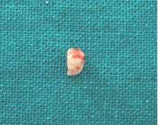 Endodontic therapy was planned for the traumatized teeth and after obtaining an access and thorough debridement an intracanal dressing of calcium Case Report: A 30 year old male reported with a