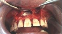 Clinical examination revealed the presence of traumatized maxillary central incisors which were non vital after radiographic evaluation vitality tests.
