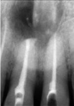 Root end resection was done in the maxillary central incisor followed prepartion of a 3mm cavity in the root apex & placement of Mineral trioxide aggregate (MTA) in the prepared Most mesiodens never
