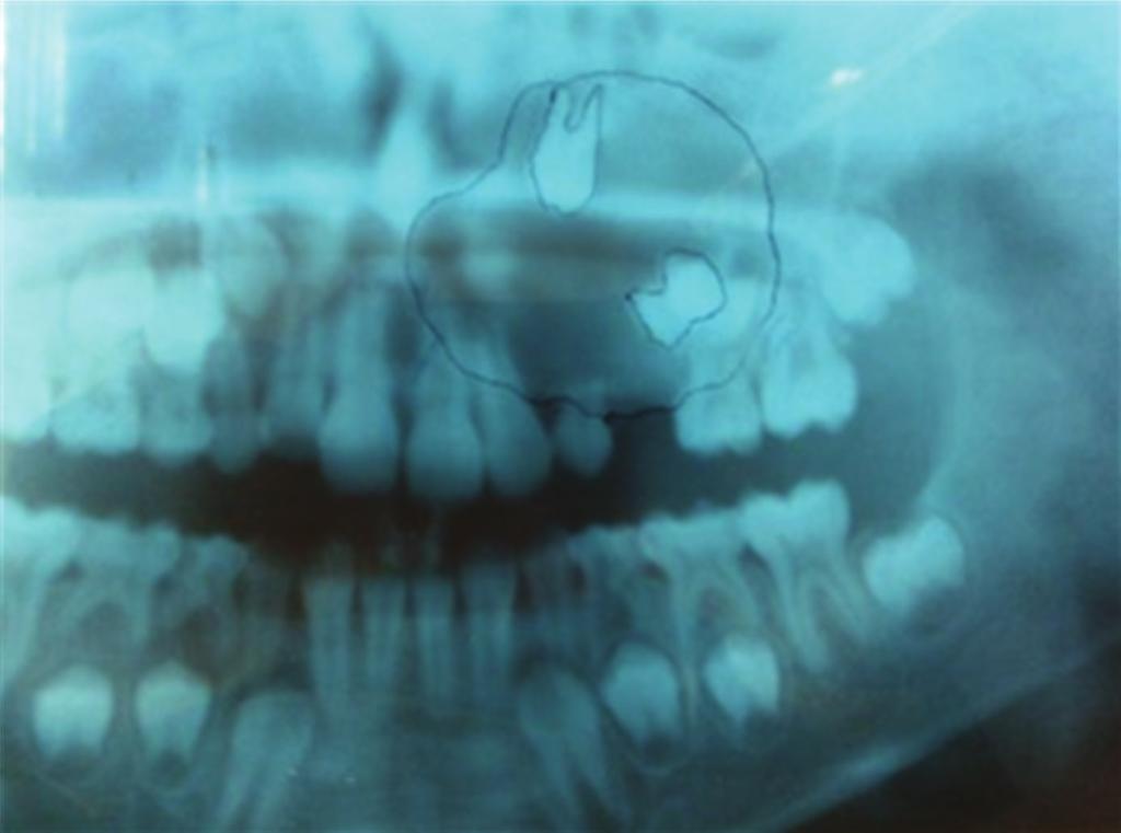 Figure 4: IOPA view showing deciduous canine and 1st premolar embedded in the cyst. 3.