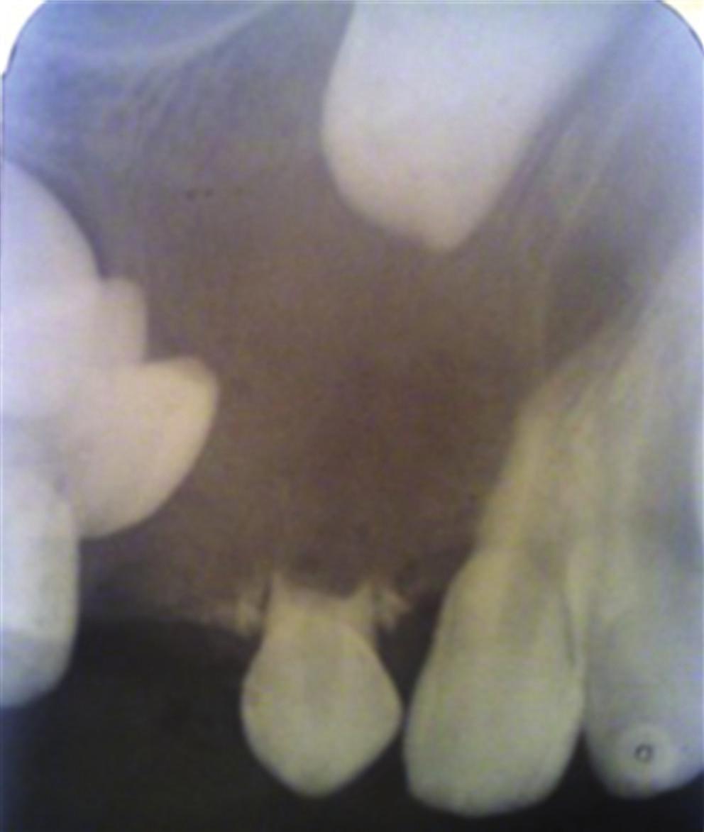 The highest incidence of dentigerous cysts occurs during the second and third decade of life.