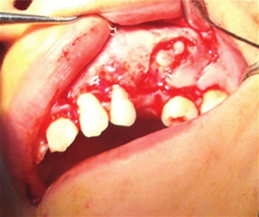 Case Reports in Dentistry 3 Figure 8: Complete cyst enucleation. Figure 6: Canine tooth embedded within the cyst. Figure 7: Premolar tooth in cyst.