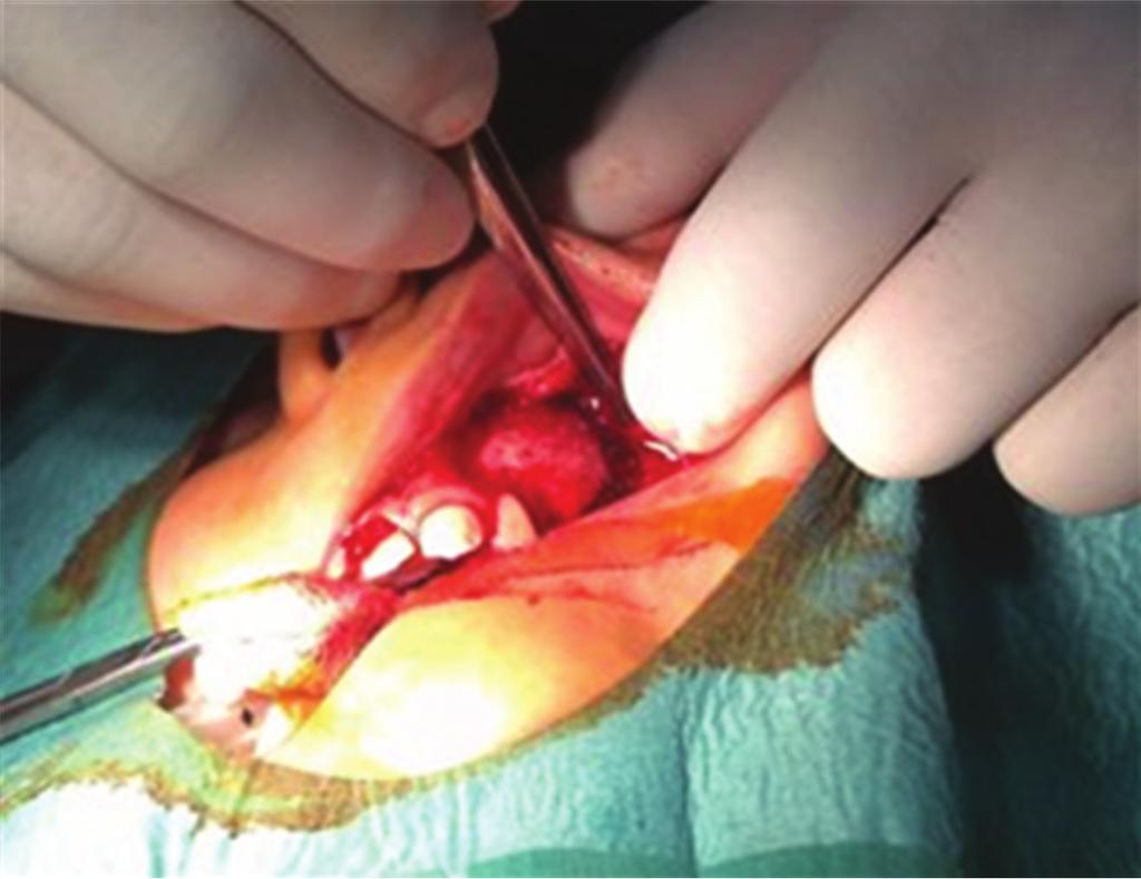 The expansion of the dentigerous cyst is related to an increase in cyst fluid osmolality and the release of bone-resorbing factors.